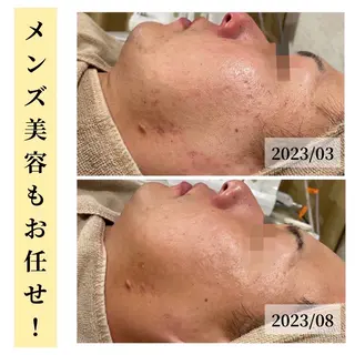 ハーブピーリング・毛穴ケア専門サロンSalon de LENA所属・ハーブピーリング 毛穴専門店/栄のエステ・リラクイメージ