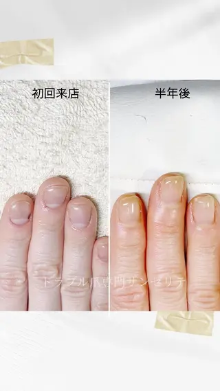ネイル 深爪・巻き爪 専門サンセリテのネイルデザイン