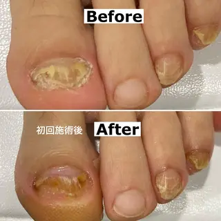 ネイル Mellow nail所属・巻爪無料モデル募集 ✨🦶MEGUMIのネイルデザイン