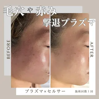 カッピング/プラズマ CHILLのエステ・リラクイメージ