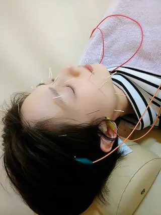 リフトアップ・たるみ ☆美容鍼小顔矯正のその他イメージ