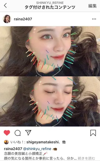 鍼灸整骨院Refine所属・鍼灸 Refineのその他イメージ