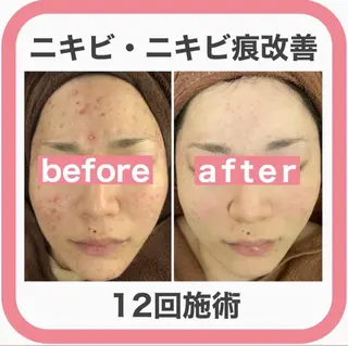 学生ニキビ改善🍀 優しい肌質改善のエステ・リラクイメージ