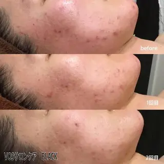 メンズ マツエク・マツパ エステ.まつげ.小顔 眉毛.プラズマ.脱毛のマツエク・マツパデザイン