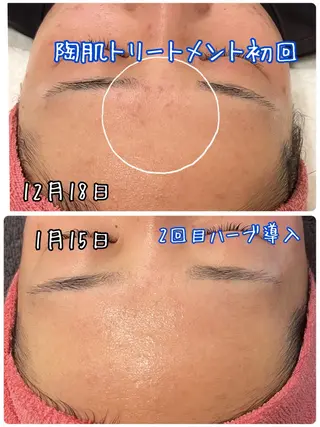 【リベルハーブピーリング認定店】敏感肌・美白脱毛専門店Dione立川店所属・Dione 立川店のエステ・リラクイメージ