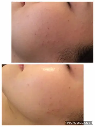 ニキビ/肌質改善専門 Snow skinのエステ・リラクイメージ