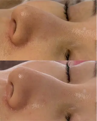 肌質改善×毛穴洗浄 ナスサロ 看護師只野のエステ・リラクイメージ