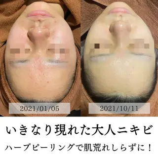 ハーブピーリング・毛穴ケア専門サロンSalon de LENA所属・ハーブピーリング 専門店/名古屋駅前店のエステ・リラクイメージ