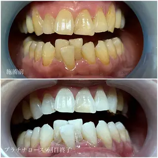 ネイル/耳つぼ /新ホワイトニングのネイルデザイン