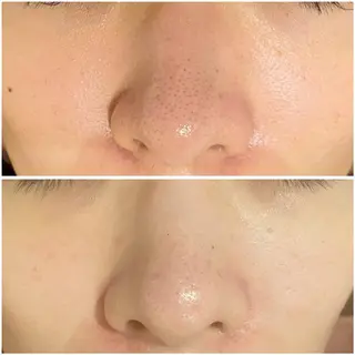 ニキビ跡改善専門🔥 医療にはできない改善のエステ・リラクイメージ