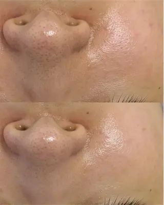 肌質改善×毛穴洗浄 ナスサロ 看護師只野のエステ・リラクイメージ