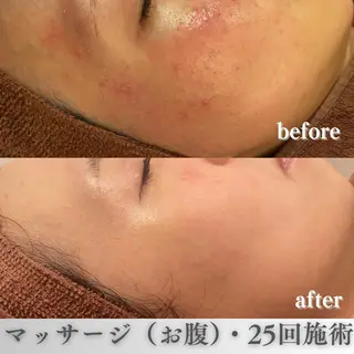 学生ニキビ改善🍀 優しい肌質改善のエステ・リラクイメージ