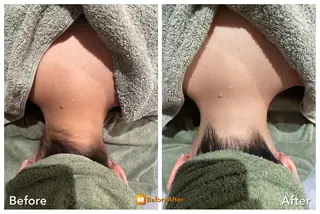 Meupニキビ専門店 背中/ハーブ/ララのその他イメージ