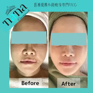 小顔痩身インディバ Nana表参道のエステ・リラクイメージ
