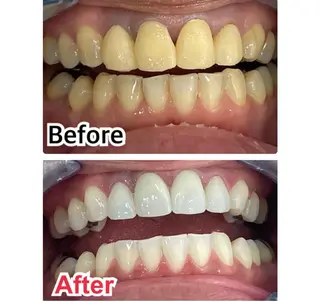 メンズ キッズ ネイル マツエク・マツパ アイブロウ プラチナムビューティー柏所属・【歯科提携】柏ホワイ トニングスタイルのその他イメージ