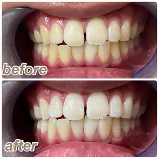 White Berry SELF BEAUTY SALON所属・セルフホワイトニング 🦷口元垢抜け✨のその他イメージ