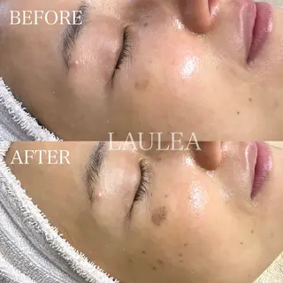 シミケア/ハーブピーリング/脱毛/小顔フェイシャル/ハーブ温浴 LAULEA所属・素肌をキレイに ラウレア🌼Hayaのエステ・リラクイメージ