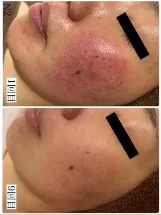 学生ニキビ改善🍀 優しい肌質改善のエステ・リラクイメージ