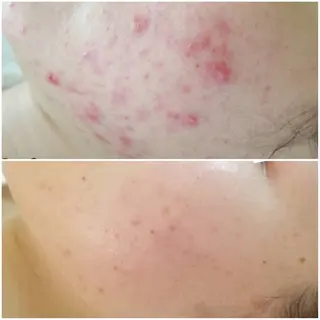 ニキビケアサロン|Motorihi【モトリヒ】所属・ニキビケア Moto rihi【モトリヒ】のエステ・リラクイメージ