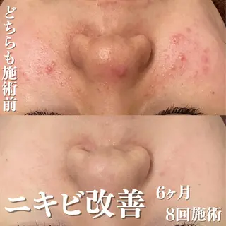 🔥3か月で肌革命 🔥ニキビ専門店のエステ・リラクイメージ