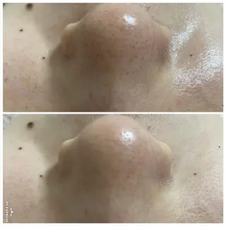 ニキビ毛穴改善 🌿ハーブピーリングのエステ・リラクイメージ