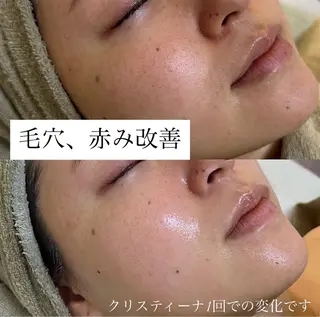 肌質改善専門サロンAte国分寺店所属・Ate Rikaのエステ・リラクイメージ