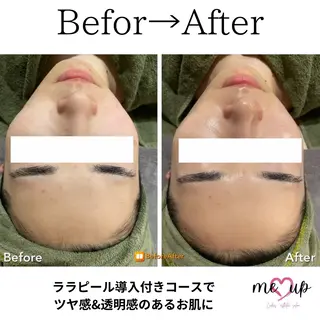 Meupニキビ専門店 背中/ハーブ/ララのその他イメージ