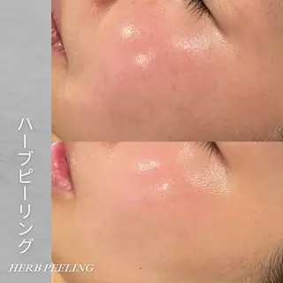 EST BEAUTY所属・顔ワックス脱毛/ ハーブピーリングのエステ・リラクイメージ