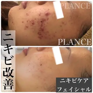 フェイシャル専門 肌質改善/プランスのエステ・リラクイメージ