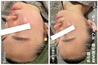 Meupニキビ専門店 背中/ハーブ/ララのその他イメージ