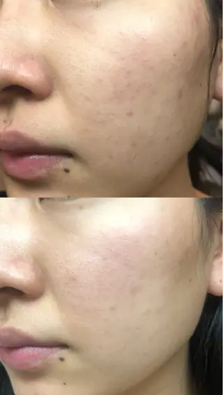 MiEL  total beaty salon所属・肌質改善サロン ナツコのエステ・リラクイメージ