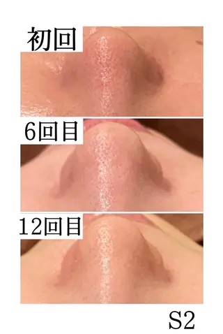 学生ニキビ改善🍀 優しい肌質改善のエステ・リラクイメージ