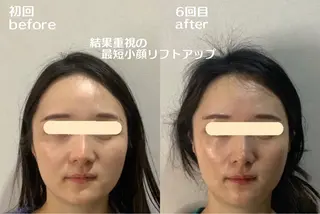 最速小顔・肌質管理 ❣️エスポワールのエステ・リラクイメージ