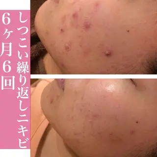 学生ニキビ改善🍀 優しい肌質改善のエステ・リラクイメージ