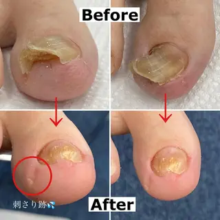 ネイル Mellow nail所属・巻爪無料モデル募集 ✨🦶MEGUMIのネイルデザイン