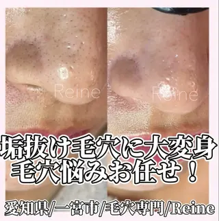Reine BeautySalon所属・毛穴/シミ肝斑/脱毛 横山梨里のエステ・リラクイメージ