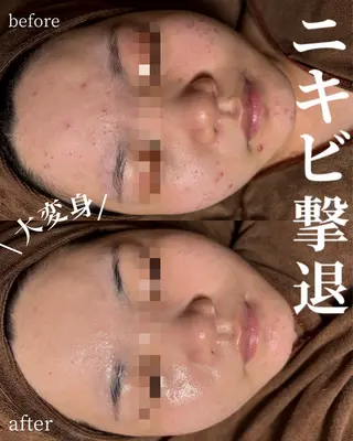 HINANO矢場町店【ヒナノ】所属・脱毛/肌改善🌿 HINANO 村田のエステ・リラクイメージ