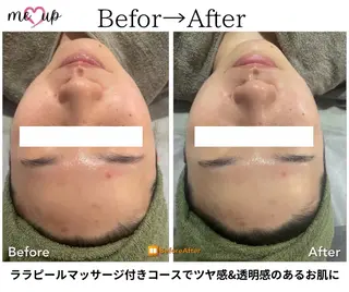 Meupニキビ専門店 背中/ハーブ/ララのその他イメージ