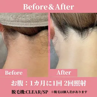 メンズ キッズ 有人型セルフサロン 脱毛/痩身/美顔のその他イメージ