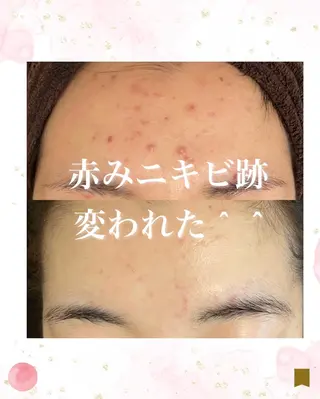 ニキビ跡専門サロン Ａｉｎａのエステ・リラクイメージ