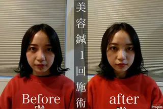 鍼灸整骨院Refine所属・鍼灸 Refineのその他イメージ