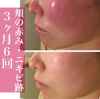 学生ニキビ改善🍀 優しい肌質改善のエステ・リラクイメージ