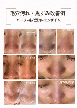 【ハーブピーリング/毛穴洗浄】NA skin 川崎店〜ニキビ・毛穴専門店〜所属・NAskin川崎 皆川のエステ・リラクイメージ