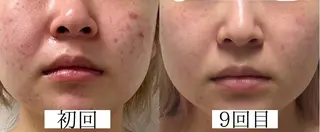 韓国美肌/肌質改善 【天神】yuiのエステ・リラクイメージ