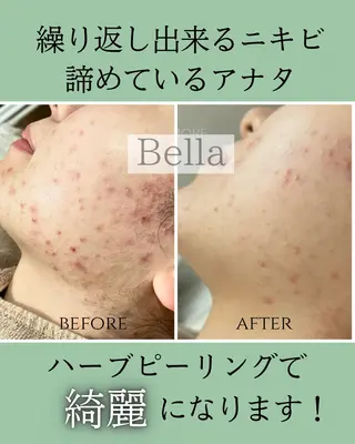 肌質改善ハーブ ピーリングBellaのエステ・リラクイメージ