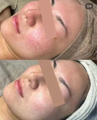 肌質改善ハーブ ピーリングBellaのエステ・リラクイメージ