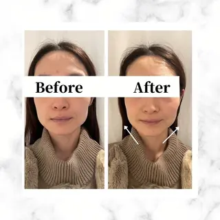 12Dハイフ💗 最強小顔のエステ・リラクイメージ