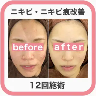 ニキビ特化型エステ 🍋最短で肌質改善のエステ・リラクイメージ