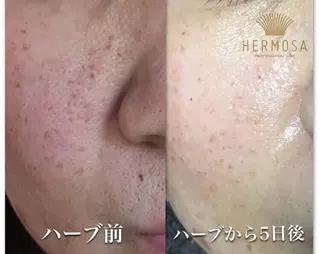 【ニキビ/肌管理】 salon varyのエステ・リラクイメージ