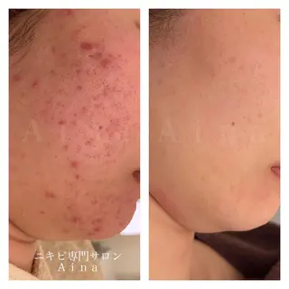 ミディアム カラー ヘアアレンジ キッズ ネイル マツエク・マツパ アイブロウ ニキビ跡専門サロン Ainaのエステ・リラクイメージ